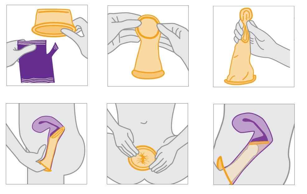 Female condom - use