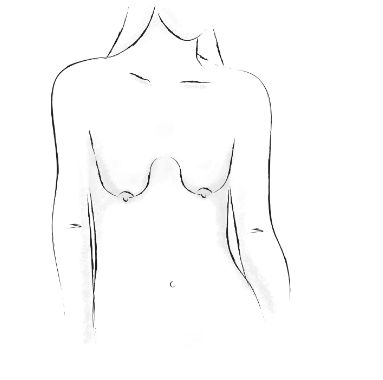 Опущенная грудь
